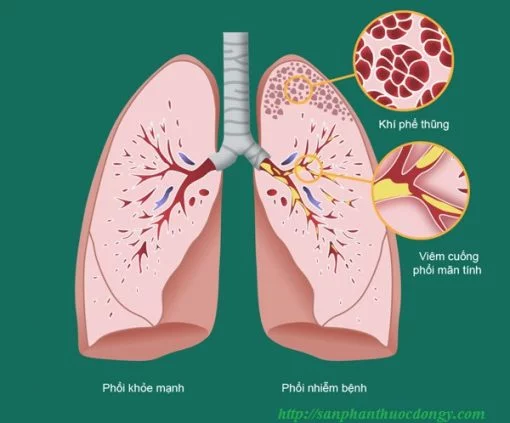 Phổi tắc nghẽn mãn tính