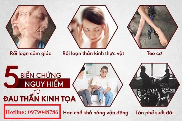 Biến chứng của bệnh đau thần kinh tọa