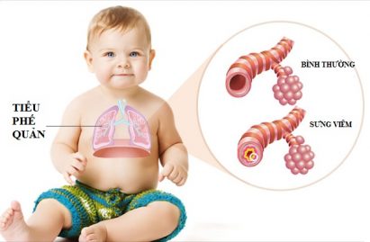 Hình ảnh Viêm tiểu phế quản ở trẻ em
