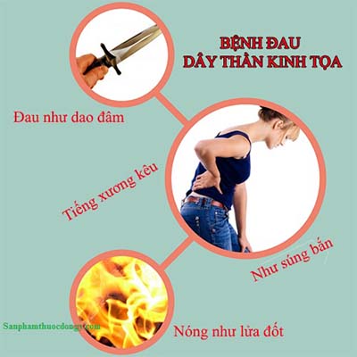 Dấu hiệu của bệnh đau thần kinh tọa