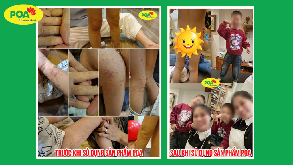 Hinh anh truoc va sau khi dung Kim Ngan Phong