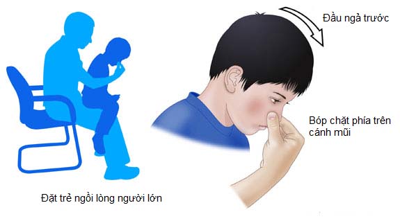 Cách xử lý khi trẻ em bị chảy máu cam